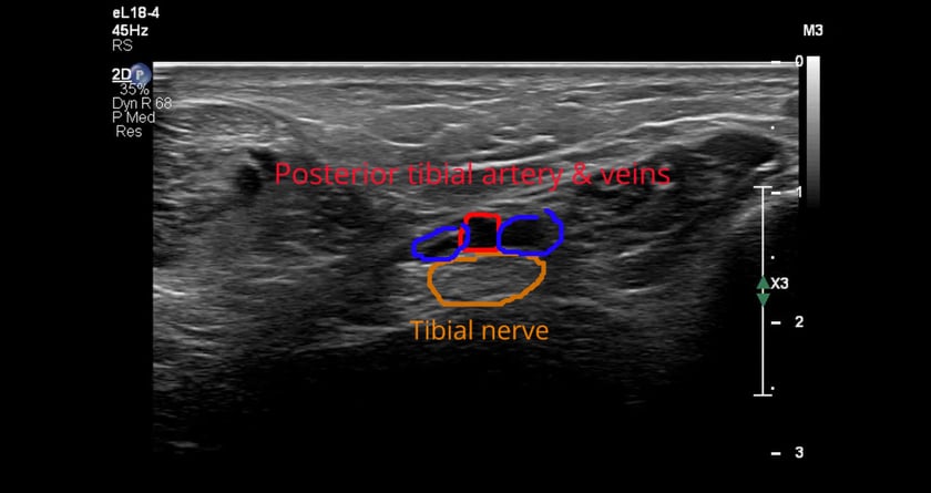 Ankle normal – ULTRASOUNDPAEDIA