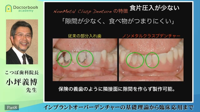 #8 ノンメタルクラスプデンチャー