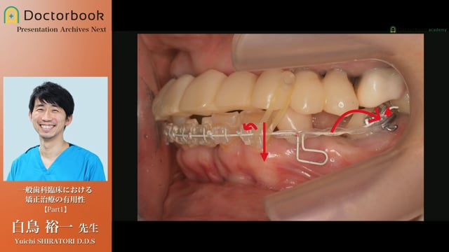 一般歯科臨床における矯正治療の有用性