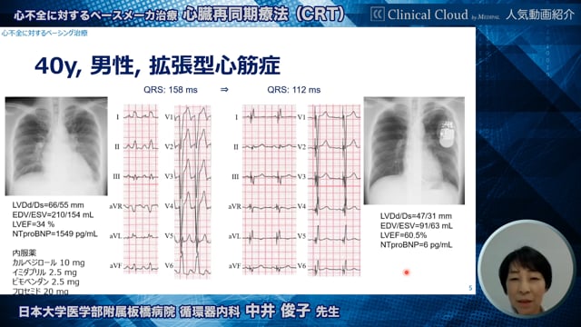 【人気動画紹介】”心不全に対するペースメーカ治療 心臓再同期療法（CRT）” ~動画ダイジェスト版~