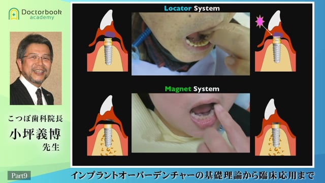 #9 片側部分義歯を可能にするマグネットIOD