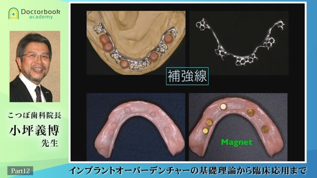 #12 マグネット義歯の注意事項