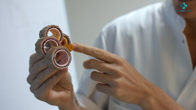 Promo diagnostiek Mijn Vaatkliniek