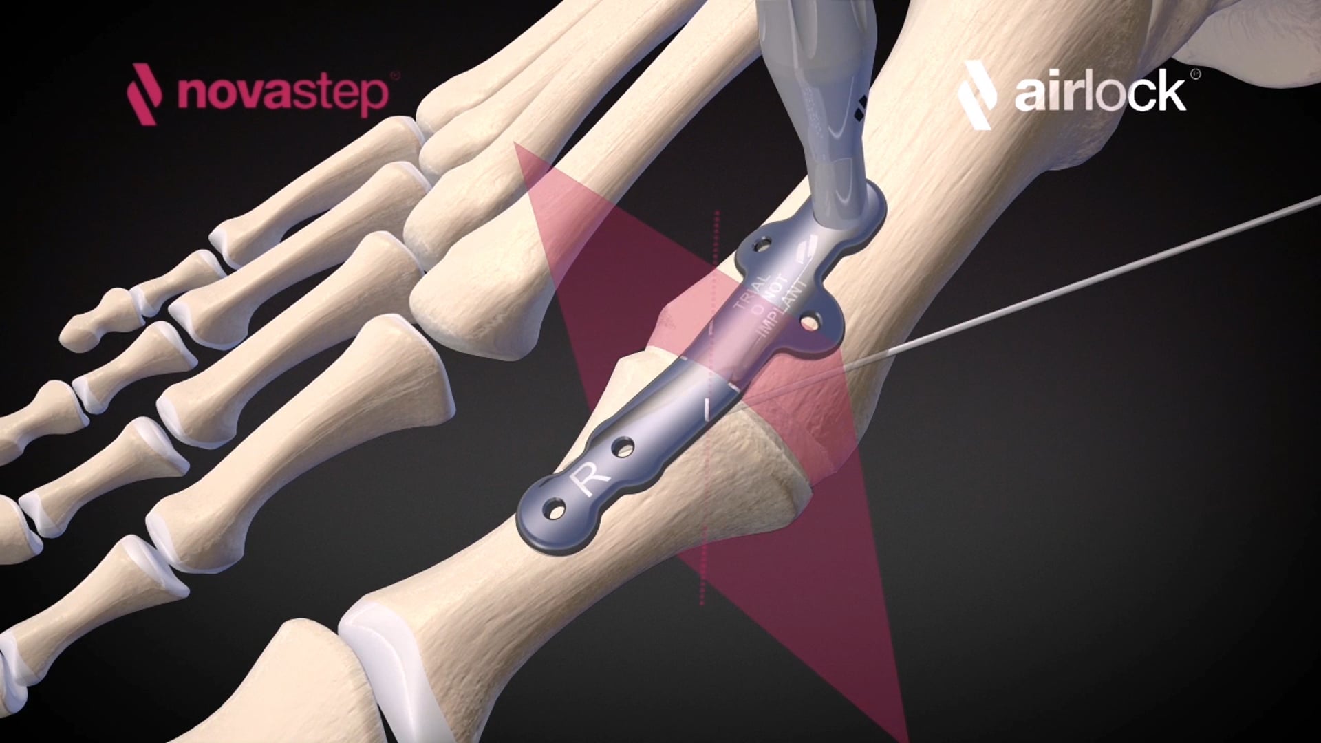 chirurgie hallux rigidus arthrodèse