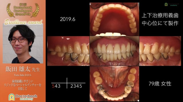 【第2回ケースレポートGP優秀発表賞】歯周組織にやさしいリジッドなパーシャルデンチャーを目指して