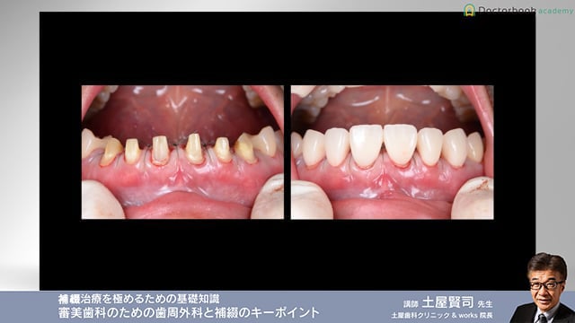 補綴治療を極めるための基礎知識「審美歯科のための歯周外科と補綴のキーポイント」