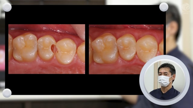 トクヤマデンタル オムニクロマのケースレポート