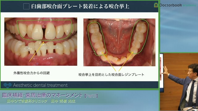 #3 歯周病患者における咬合治療、矯正治療の治療戦略