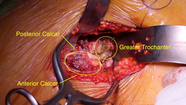 Anterior Approach THA Using the RotexTable Automated Leg Positioning Device – Surgical Technique