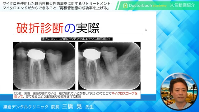 【Doctorbook academy 人気動画紹介】マイクロを使用した難治性根尖性歯周炎に対するリトリートメント