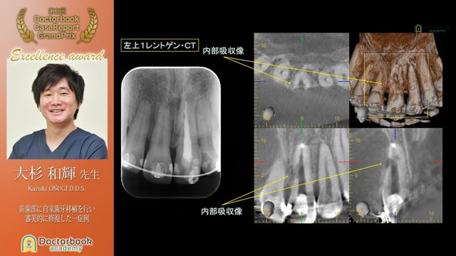 【第2回ケースレポートGP 優秀発表賞】前歯部に自家歯牙移植を行い審美的に回復した一症例