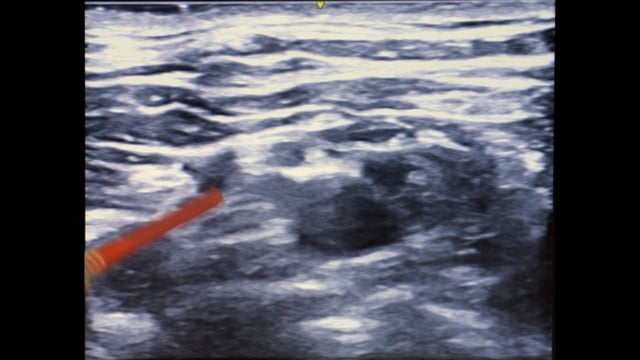 Supraclavicular and Interscalene Brachial Plexus Block for Total Shoulder Replacement