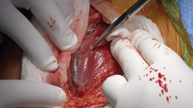 Deltopectoral Approach for Total Shoulder Arthroplasty