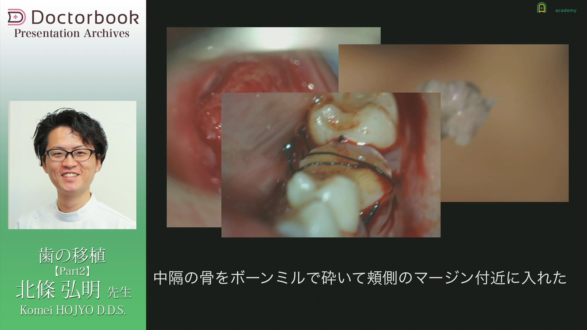 #2 GBRとエムドゲインを併用した症例
