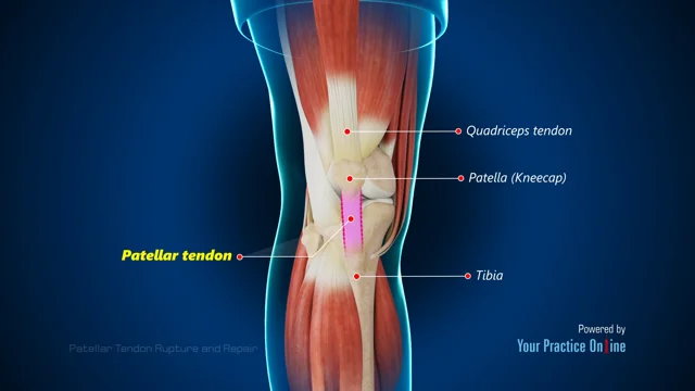 Patellar Tendon Rupture Houston, TX