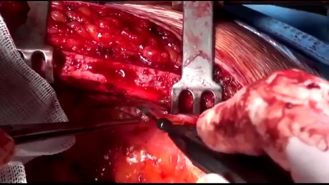 Watch an Electrocautery Procedure 