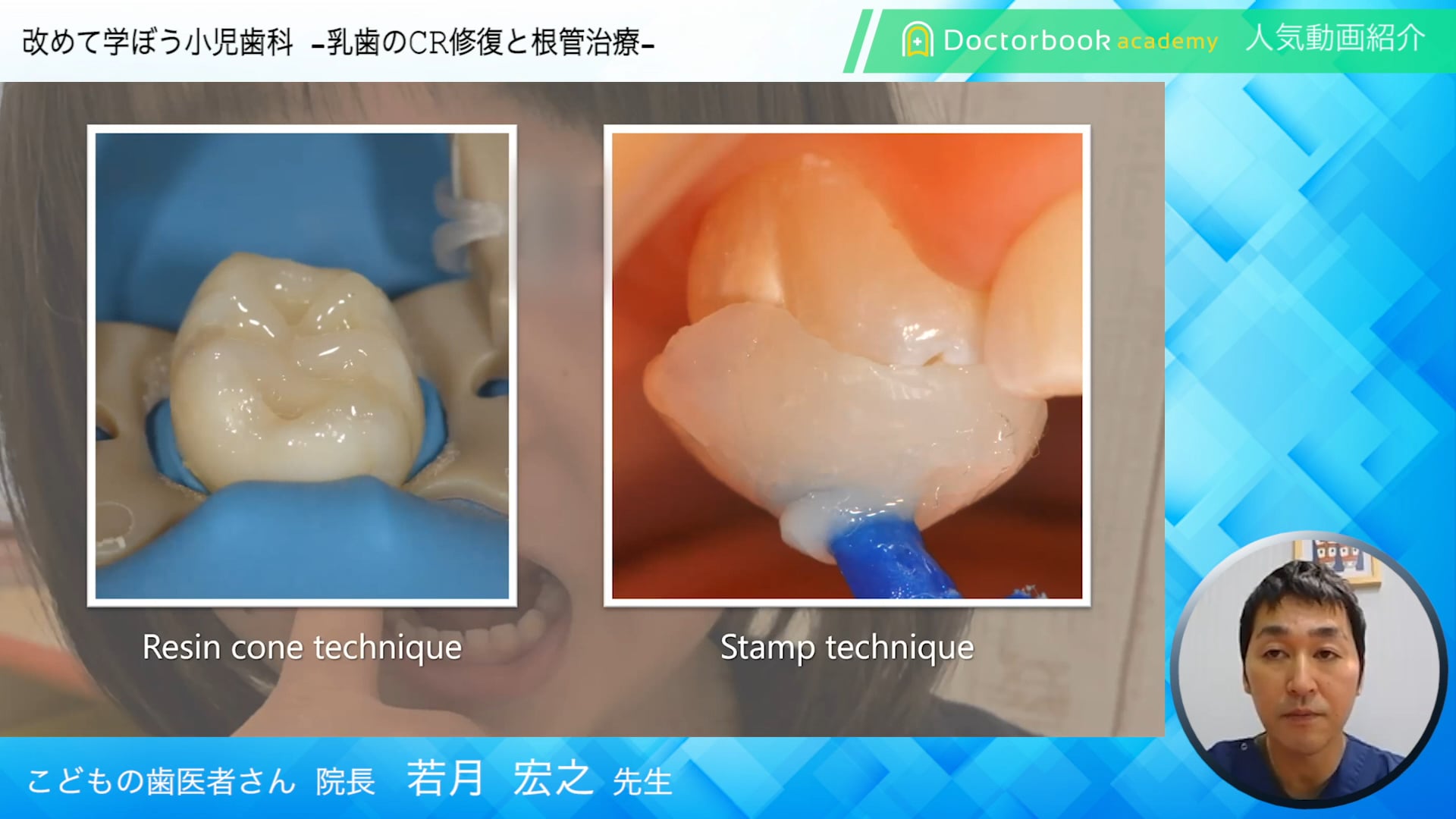【Doctorbook academy 人気動画紹介】改めて学ぼう小児歯科 乳歯のCR修復と根管治療