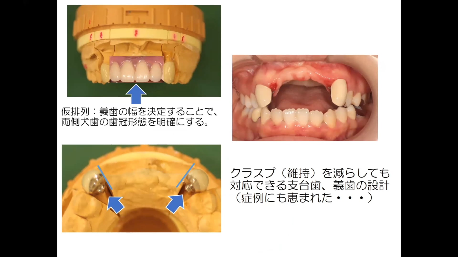 #1 Denture Cafe 第12回「ライフステージを考慮した部分床義歯治療 Part1」〜若年層への義歯治療の難しさ〜