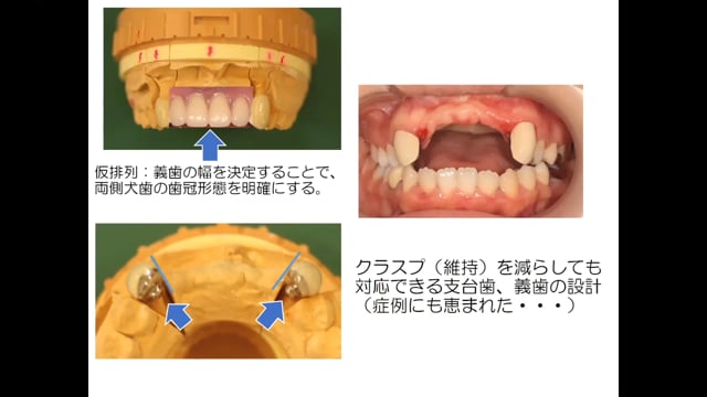 #1 Denture Cafe 第12回「ライフステージを考慮した部分床義歯治療 Part1」〜若年層への義歯治療の難しさ〜