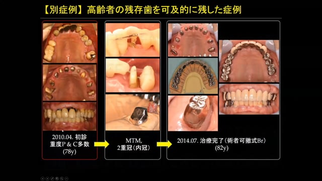 #2 Denture Cafe 第12回「ライフステージを考慮した部分床義歯治療 Part1」〜若年層への義歯治療の難しさ〜