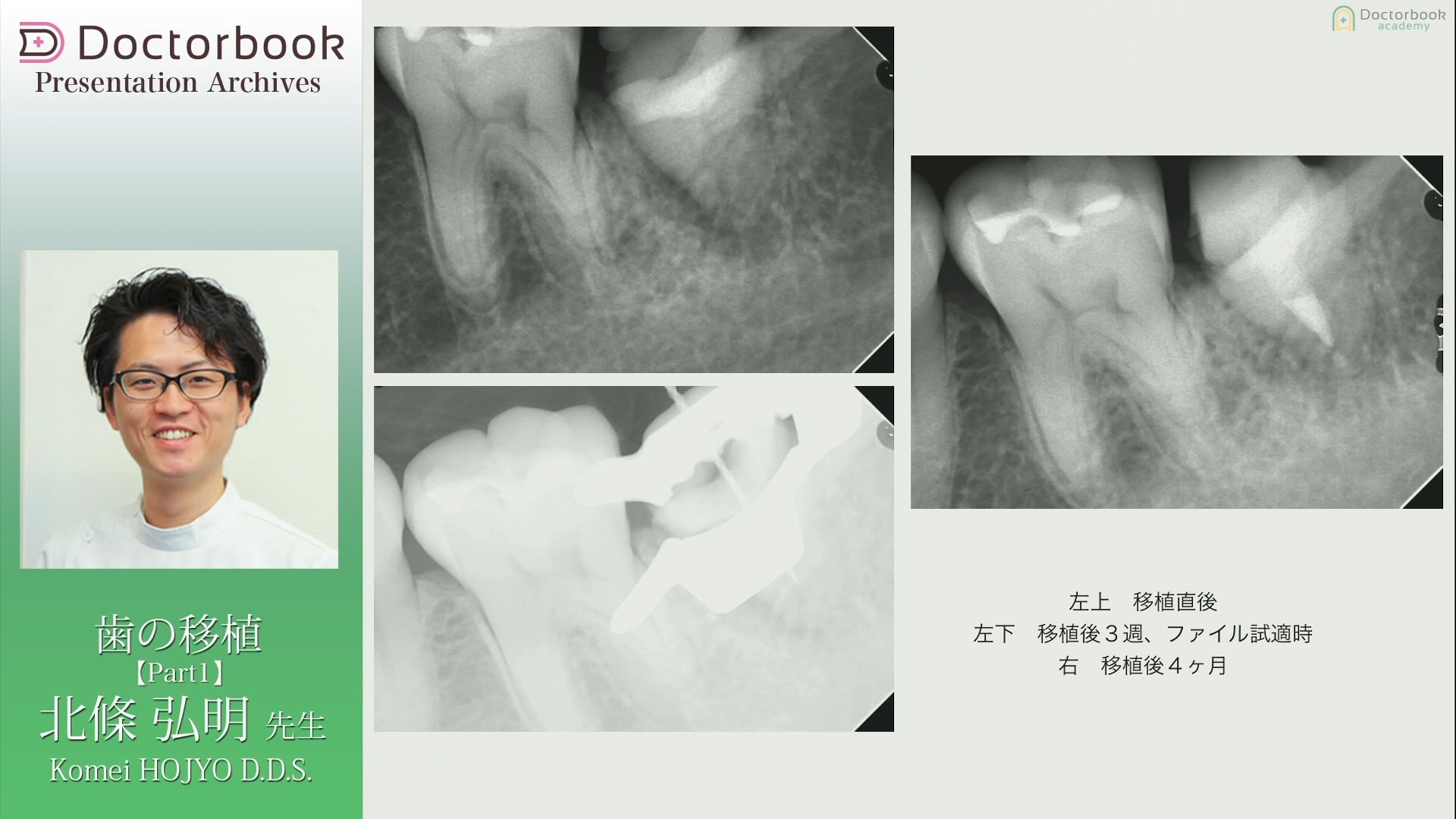 #1 左下７抜歯窩に水平埋伏歯を移植した症例