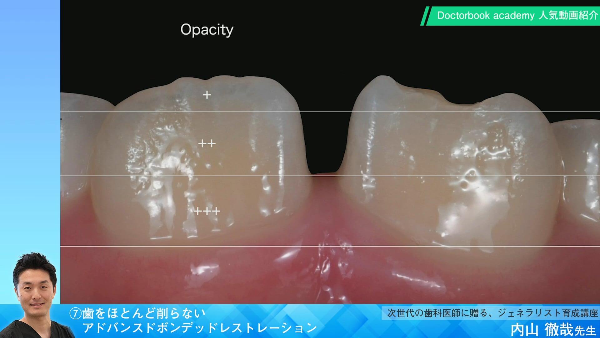 【Doctorbook academy 人気動画紹介】⑦歯をほとんど削らないアドバンスドボンデッドレストレーション