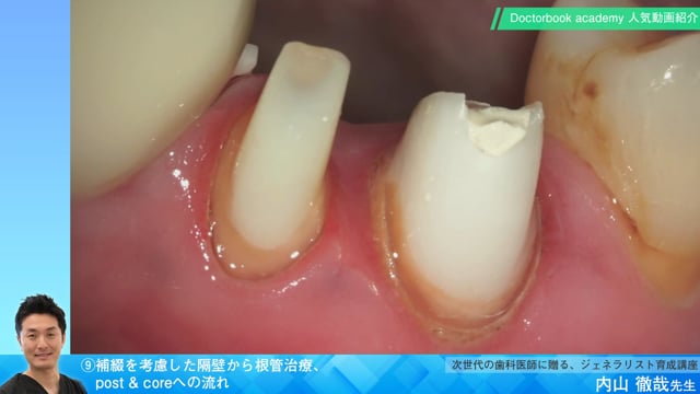 【Doctorbook academy 人気動画紹介】⑨補綴を考慮した隔壁から根管治療、post & coreへの流れ