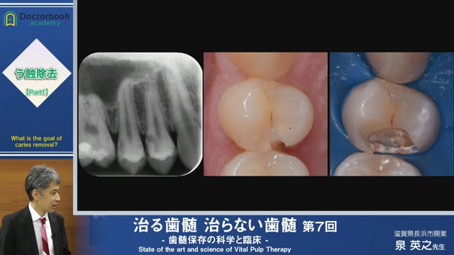 治る歯髄 治らない歯髄 - 歯髄保存の科学と臨床 - 第７回 「う蝕除去 