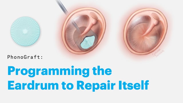 Tympanic Membrane Perforation Repair