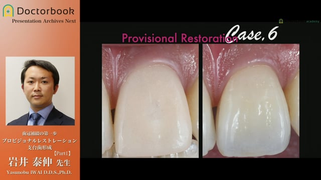 歯冠補綴の第一歩 プロビジョナルレストレーション支台歯形成