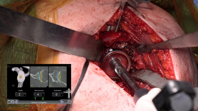 Total Shoulder Arthroplasty Using Intra-Operative 3D Navigation