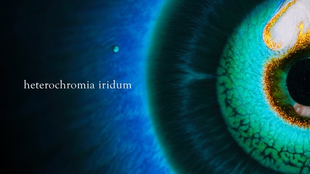 heterochromia iridum