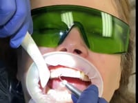 "Shining a Light on Oral Health: The Advantages of Laser Bacterial Reduction in Dental Cleaning"