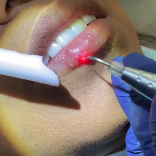 Treatment of a Herpetic Lesion with the Biolase Epic Hygiene Diode Laser