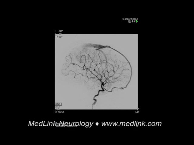 Fistulous shunt: digital subtraction angiography, post-intervention (1)
