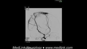 Fistulous shunt: digital subtraction angiography, pre-intervention (1)