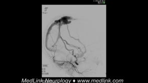 Fistulous shunt: digital subtraction angiography, pre-intervention (2)