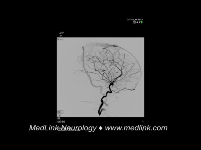 Fistulous shunt: digital subtraction angiography post-intervention (2)