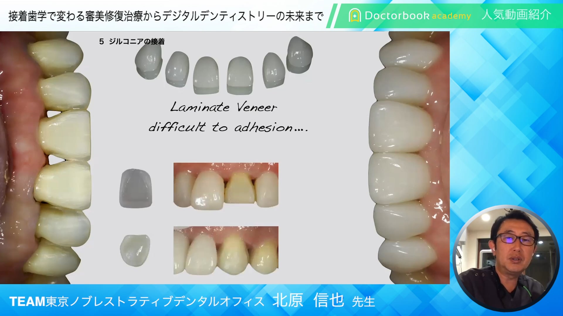 【Doctorbook academy 人気動画紹介】接着歯学で変わる審美修復治療からデジタルデンティストリーの未来まで