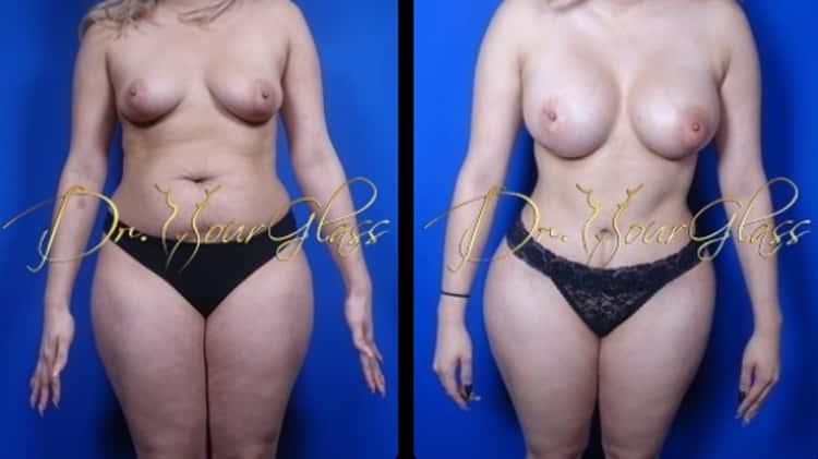 Beautiful Breasts and Waist After Mommy Makeover Procedure