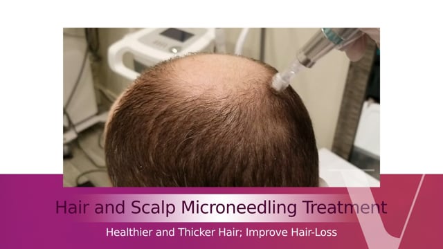 Microneedling Treatment for Hair Loss - Viola Laser and Skin Care Clinic