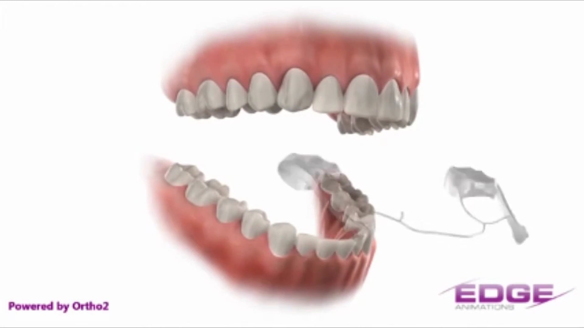 Herbst Appliance Blackburn Orthodontics on Vimeo