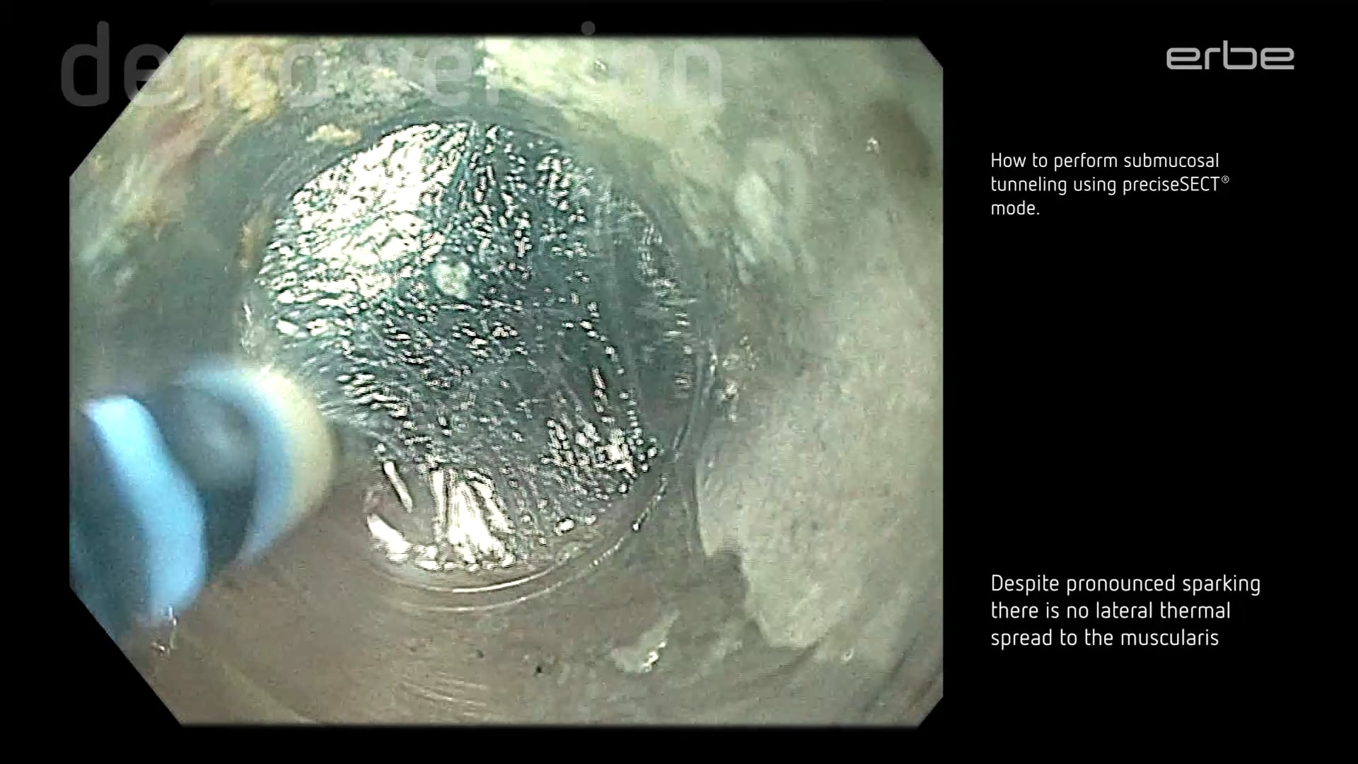 POEM with HybridKnife® using preciseSECT - step by step descriptions on dissection and coagulation