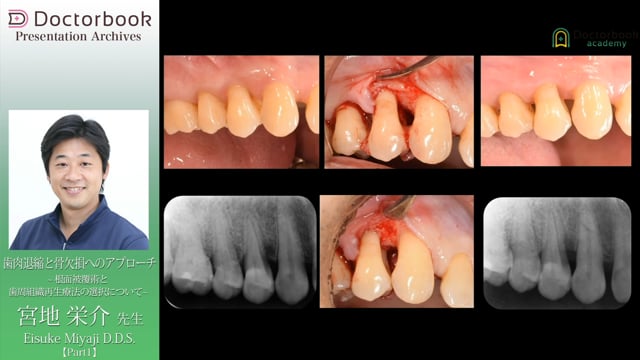 歯肉退縮と骨欠損へのアプローチ 〜根面被覆術と歯周組織再生療法の選択について〜