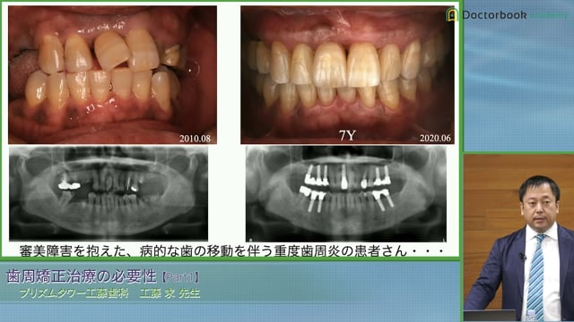 歯周病患者に対する矯正治療はNG？「歯周矯正の必要性」PART1 