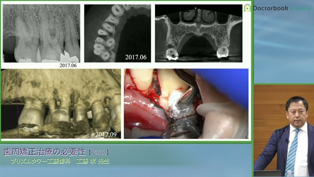 頬側ClassⅡ 分岐部の再生療法 #2