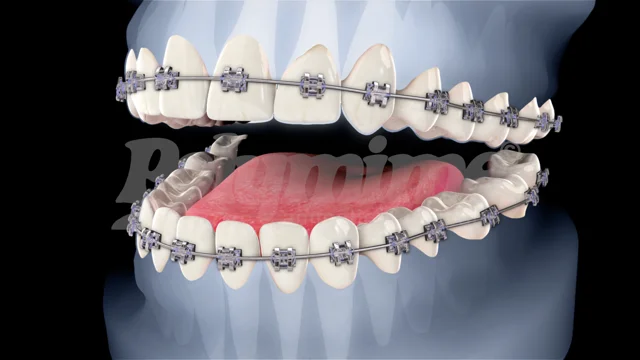 Dental braces cost in Saudi Arabia