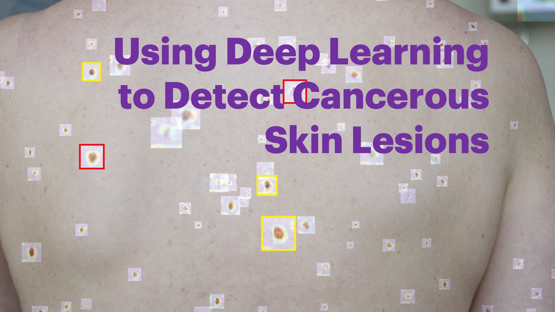 Using deep learning to detect cancerous skin lesions