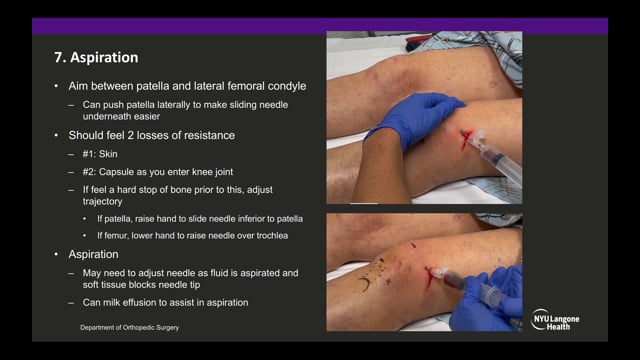 Superolateral Approach to Knee Aspiration