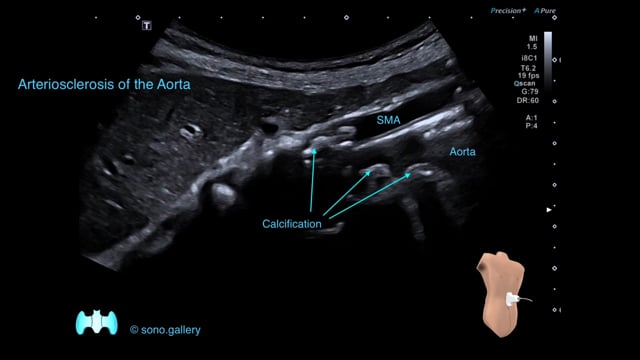 Arteriosclerosis of the Aorta (Twinkling Artifact)